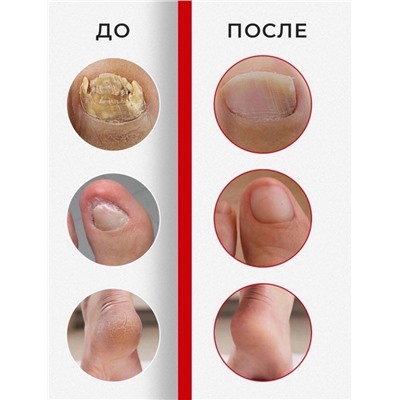 Крем для лечения грибка ногтей Nail Fungus Treatment Cream 20g